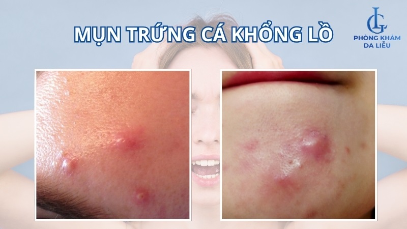 mụn trứng cá khổng lồ