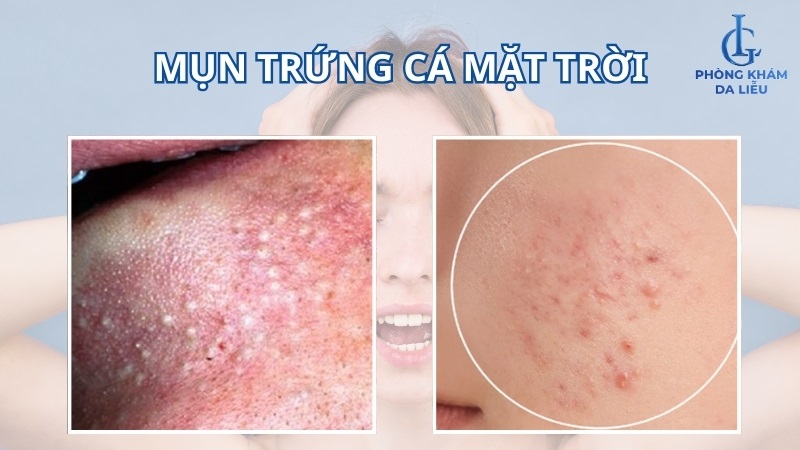 mụn trứng cá mặt trời