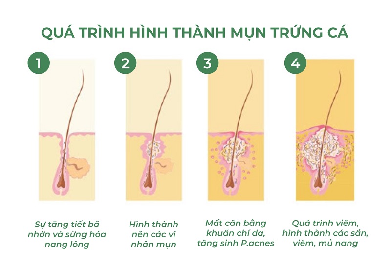 quá trình hình thành mụn trứng cá L70