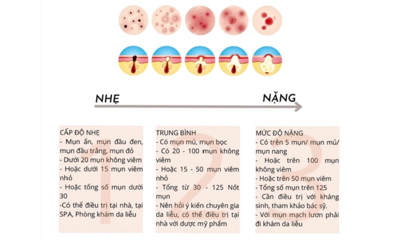 mức độ mụn từ nhẹ đến nặng