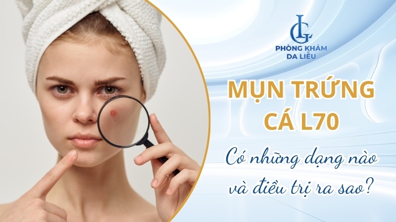 Mụn trứng cá L70 là gì?