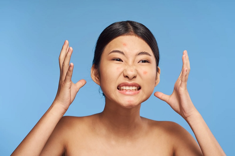 Nguyên nhân gây ra mụn do stress