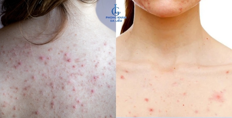 mụn lưng và mụn ngực