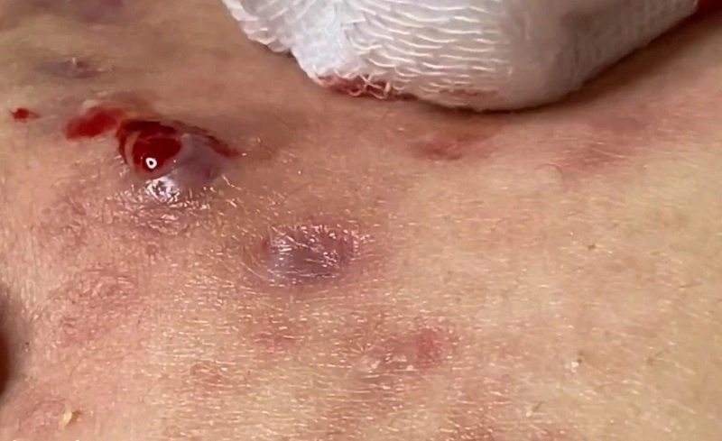 nặn mụn nang ở lưng