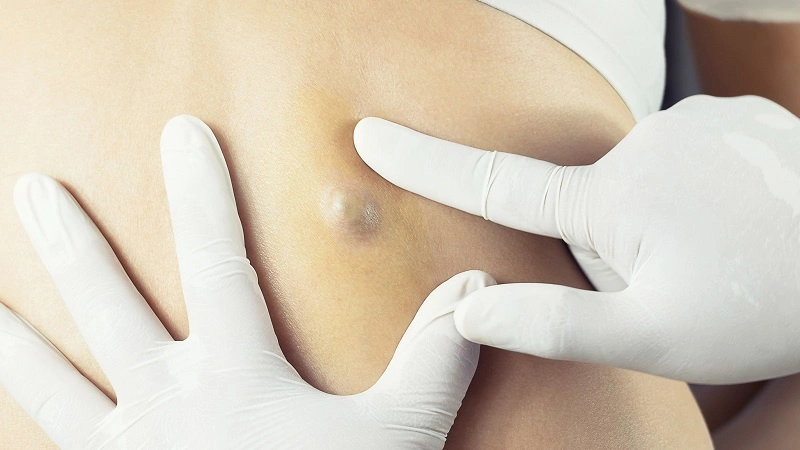 mụn sưng to ở lưng