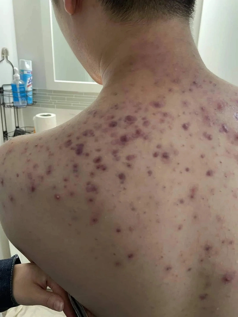 Mụn nang lưng sưng to