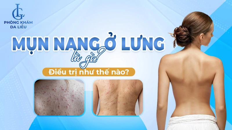 Mụn nang ở lưng