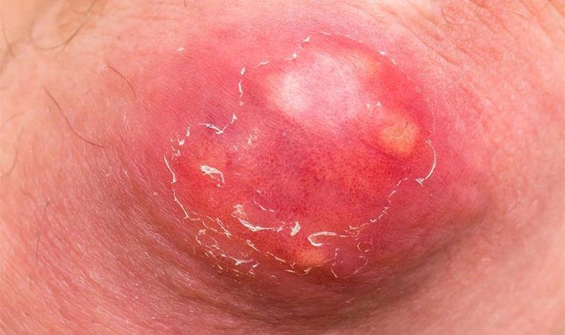 hình ảnh mụn nhọt​