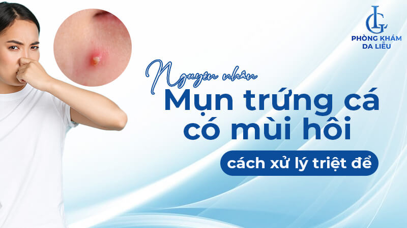 Nguyên nhân khiến mụn trứng cá có mùi hôi