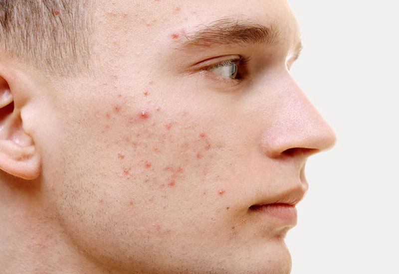 Có nên chờ mụn trứng cá tự hết?