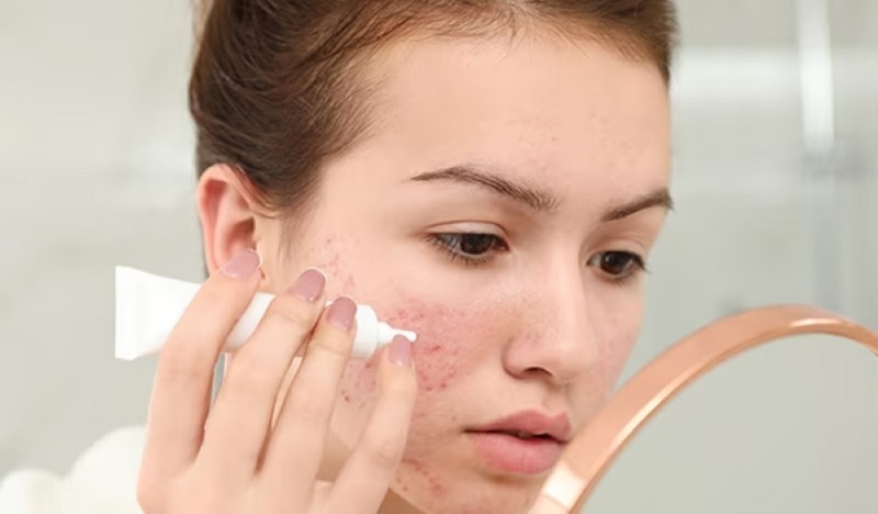 thuốc bôi trị mụn trứng cá đỏ