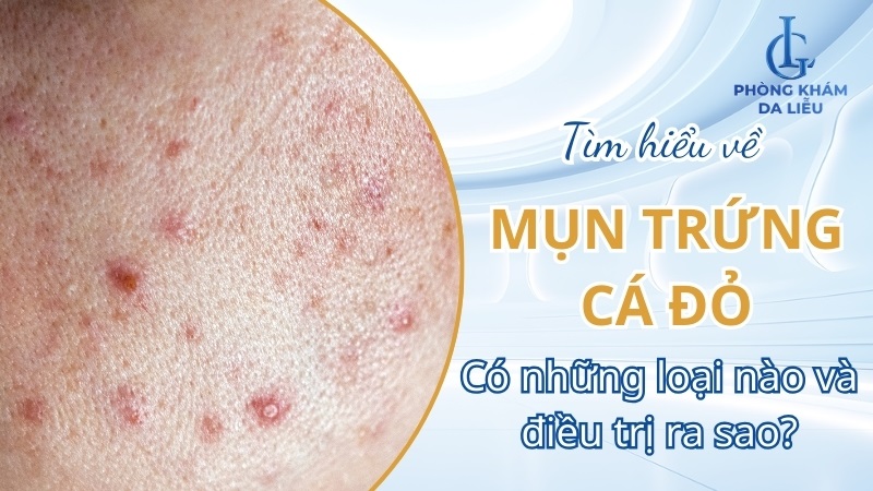 mụn trúng cá đỏ là gì