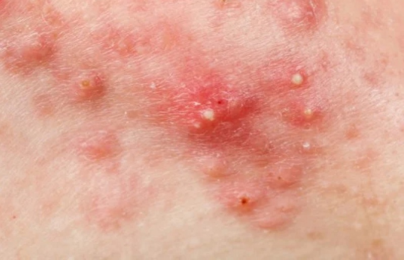 mụn trứng cá có mủ