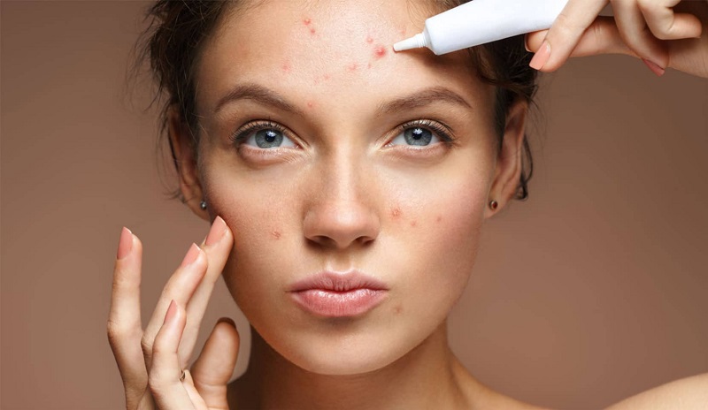 thoa thuốc trị mụn trứng cá mủ