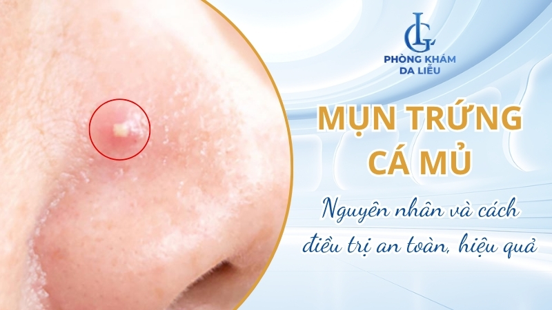 Mụn trứng cá mủ