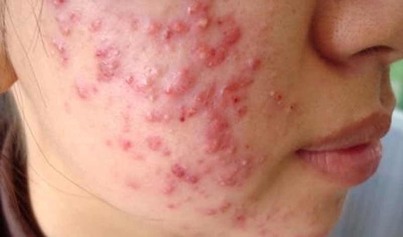 Các dạng mụn trứng cá nặng