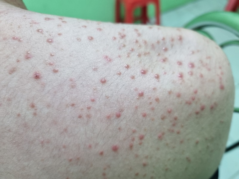 Mụn trứng cá nặng ở lưng