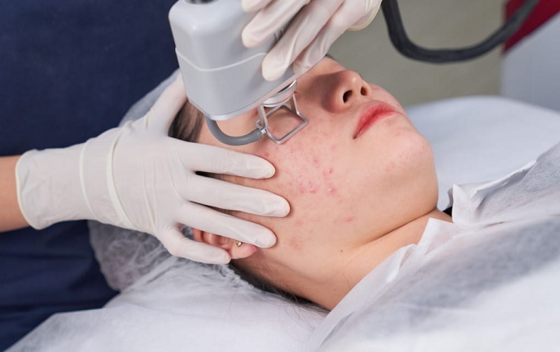 trị mụn trứng cá nặng tại phòng khám da liễu