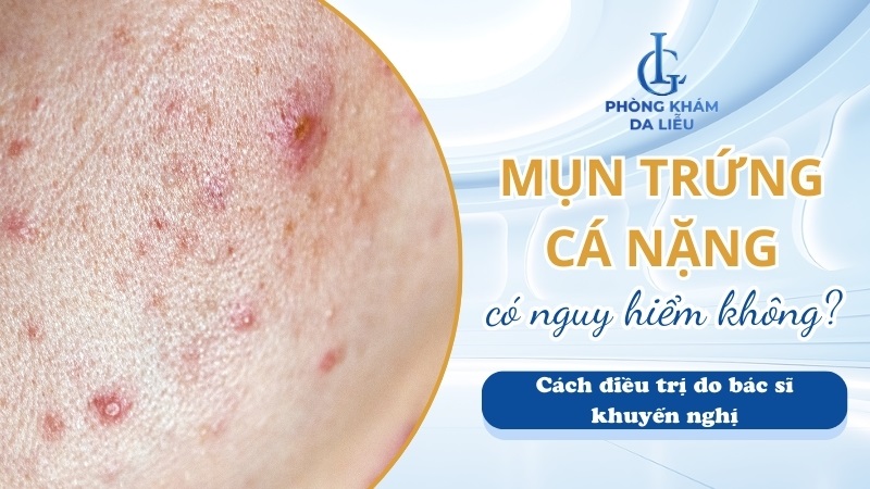 Mụn trứng cá nặng