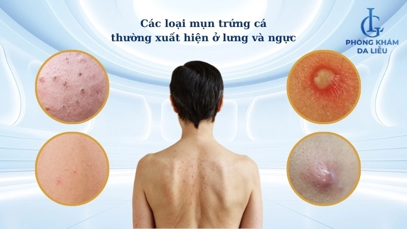 các loại mụn trứng các ở lưng