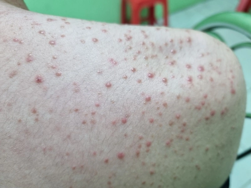 nguyên nhân gây mụn trứng cá ở lưng