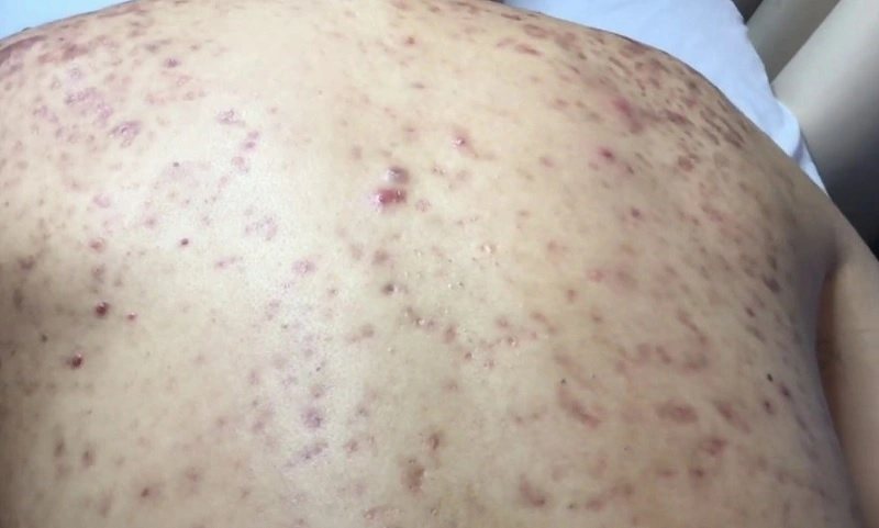 mụn trứng cá ở lưng