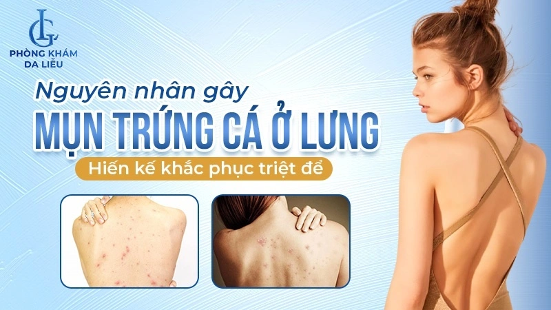 Mụn trứng cá ở lưng là gì