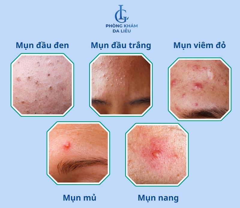 Các loại mụn trứng cá trên trán