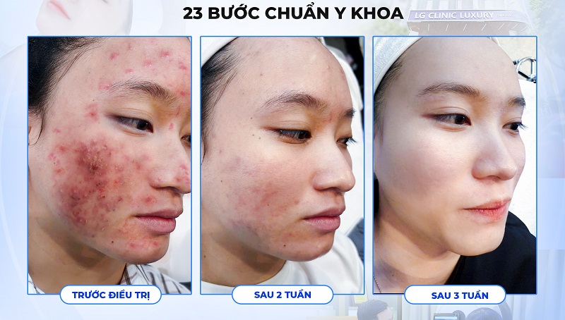 kết quá điều trị mụn trứng cá tại phòng khám da liễu LG