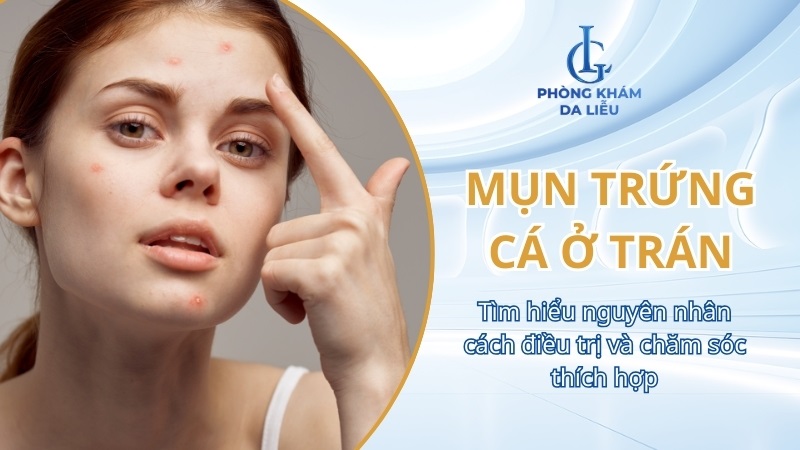 mụn trứng cá ở trán