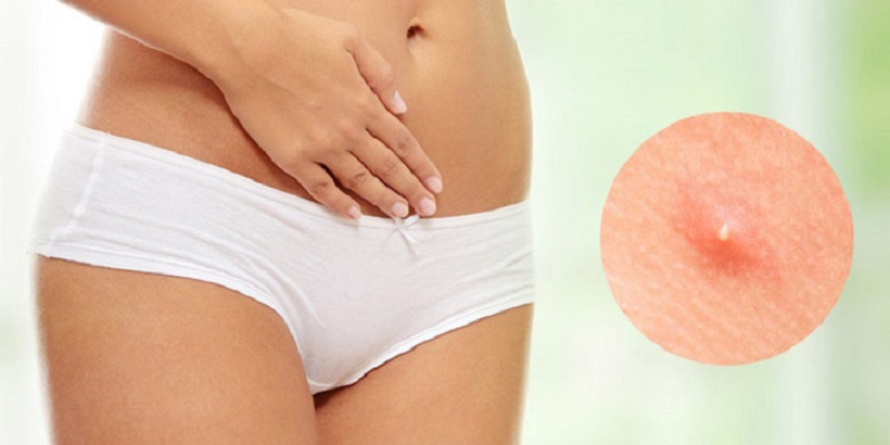 mọc mụn trứng cá ở vùng kín nữ​