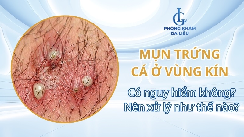 Mụn trứng cá ở vùng kín