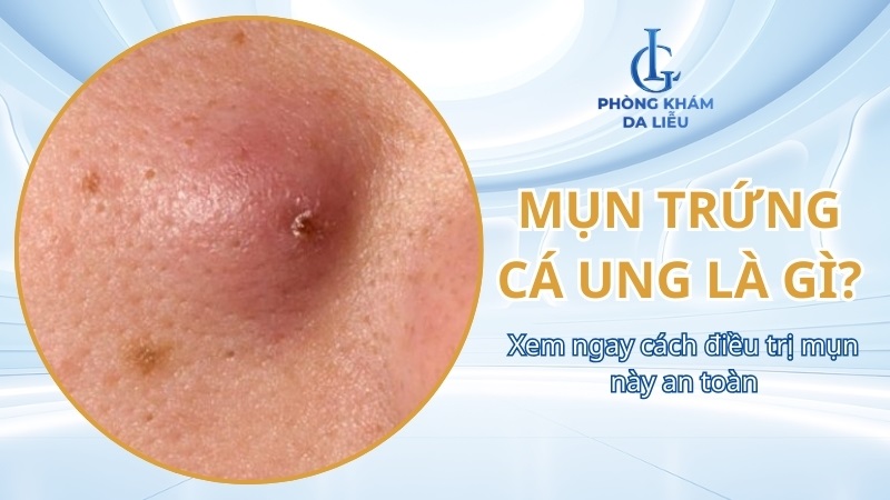 Mụn trứng cá ung