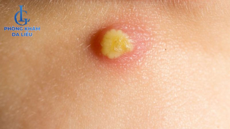 Mụn bọc, mụn nang