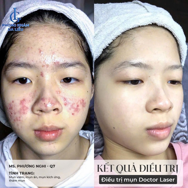 Hình ảnh trước và sau khi trị mụn tại phòng khám da liễu LG