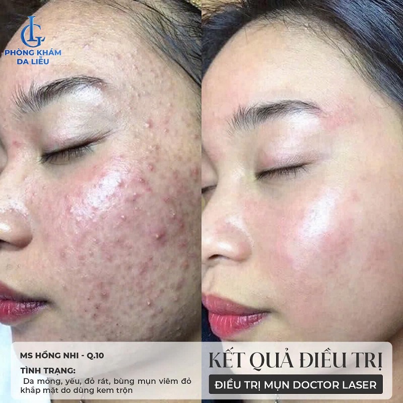 Hình ảnh trước và sau khi trị mụn tại phòng khám da liễu LG