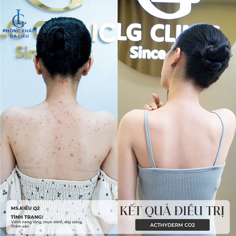 Hình ảnh trước và sau khi trị mụn tại phòng khám da liễu LG