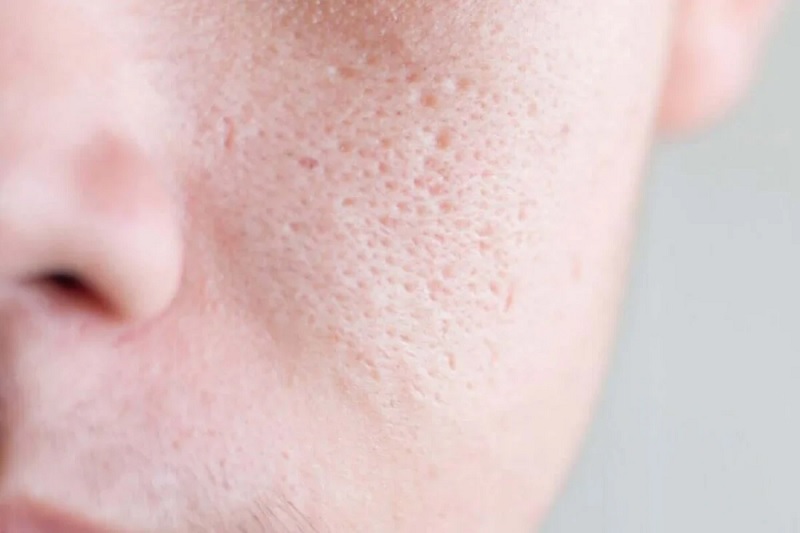 Lỗ chân lông to là 1 trong những nguyên nhân gây mụn