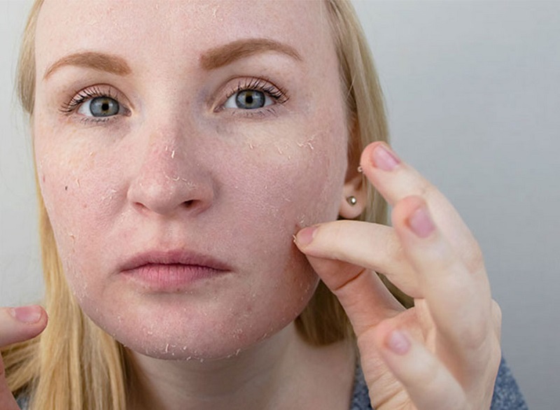 Tế bào chết tích tụ