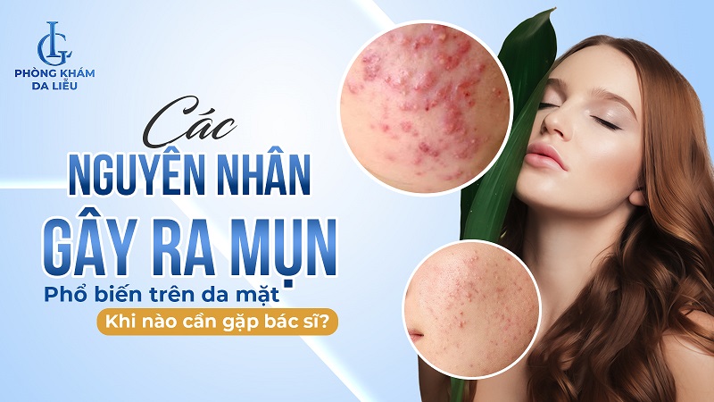 nguyên nhân gây mụn