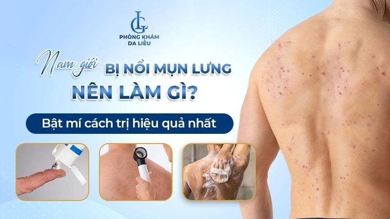 nổi mụn lưng ở nam giới
