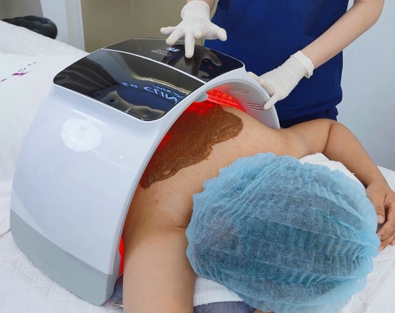 Liệu pháp ánh sáng xanh trị mụn lưng