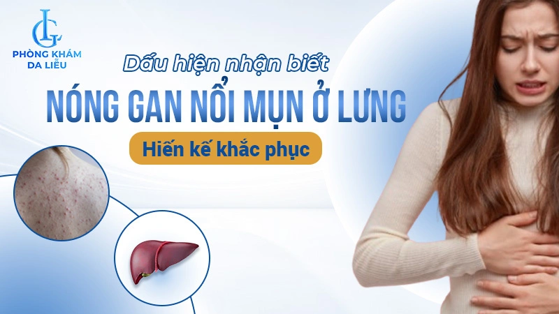 nóng gan nổi mụn ở lưng