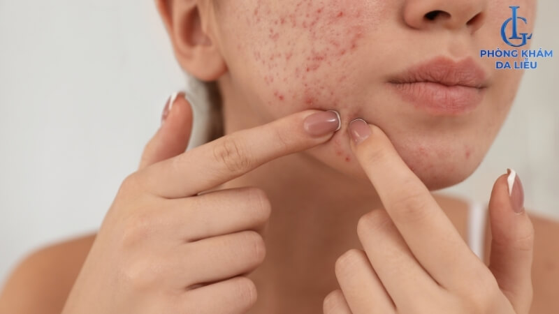 Phát ban mụn trứng cá ở mặt