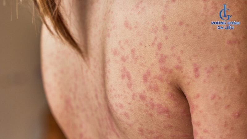 Mụn trứng cá phát ban ở lưng