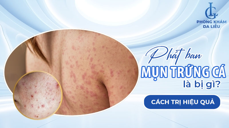 Phát ban mụn trứng cá