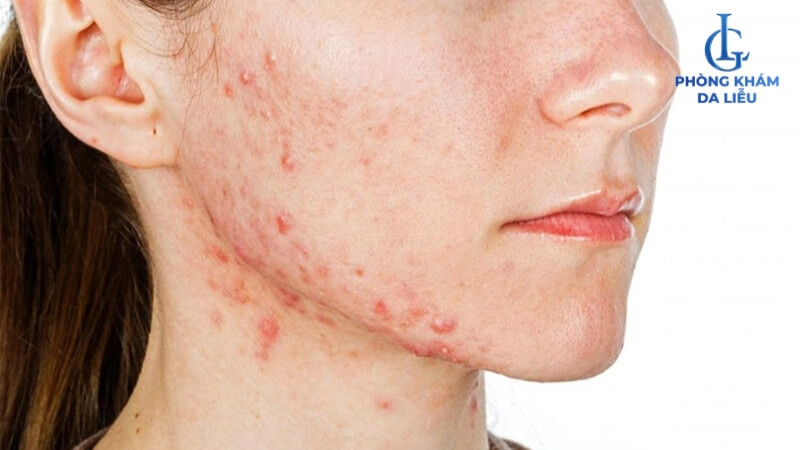 Dị ứng thuốc tây gây ra mụn