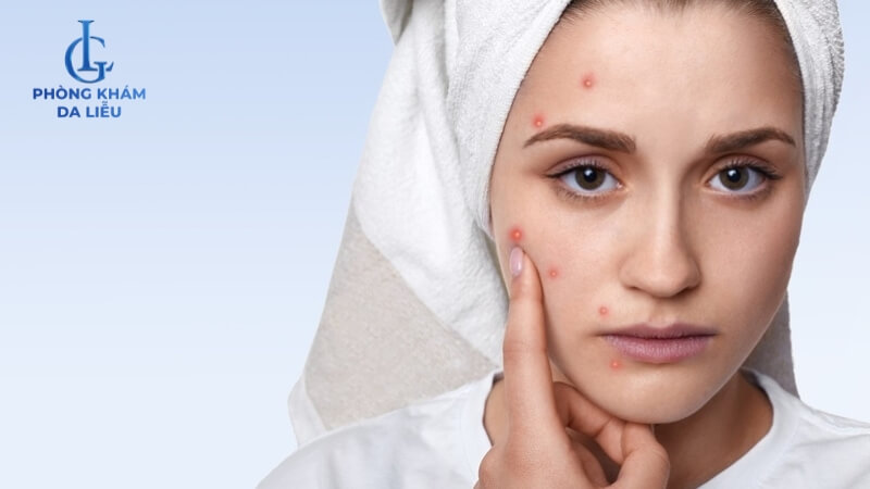 Bị nổi mụn khi uống thuốc tây