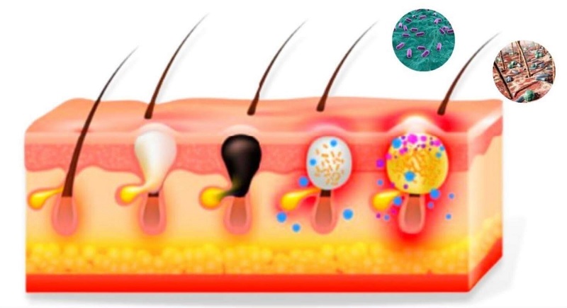 vi khuẩn P. acnes hình thành mụn