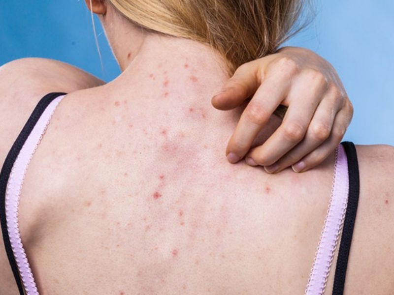 Viêm nang lông ở lưng